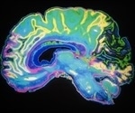 New method can kill aggressive brain tumors